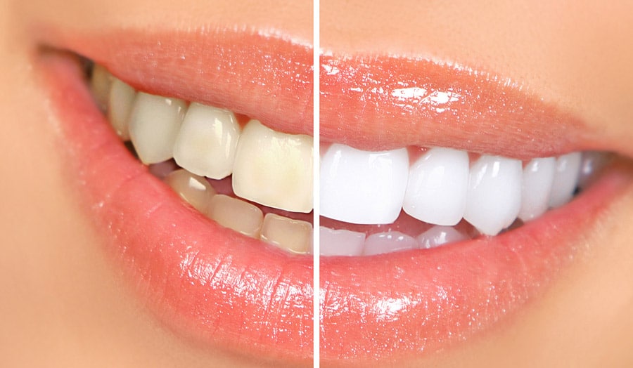 Teeth Whitening Reston