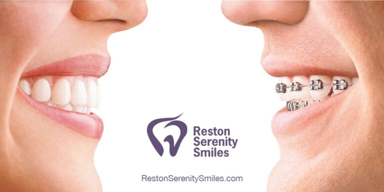 Invisalign - Reston, VA
