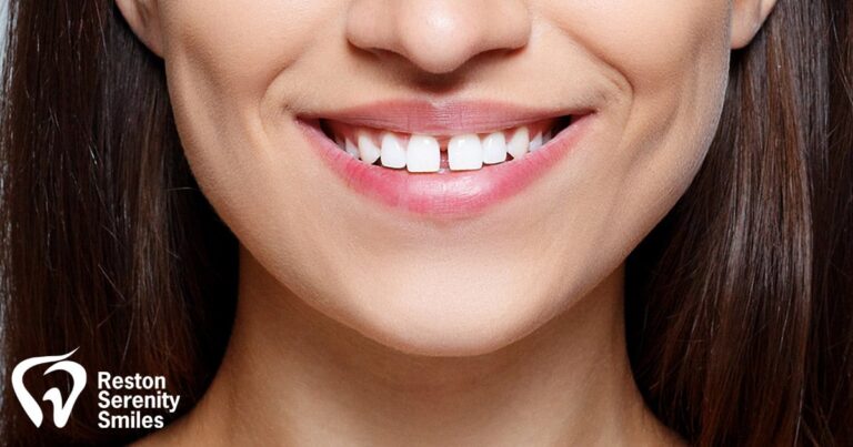Tooth Replacement